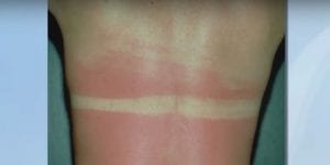 How to Treat Sunburn
