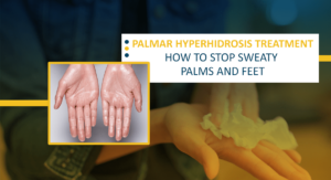 Palmar Hyperhidrosis Treatment