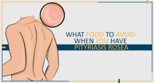 What Food to Avoid When You Have Pityriasis Rosea