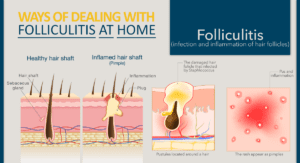 Ways of Dealing With Folliculitis at Home