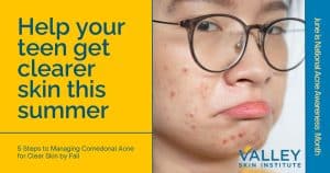 Comedonal Acne on teen girl