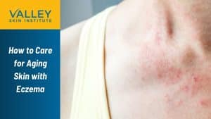 How to Care for Aging Skin with Eczema