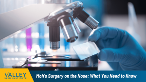 Moh's Surgery on the Nose What You Need to Know