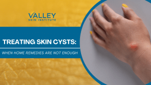 Treating Skin Cysts: When Home Remedies Are Not Enough