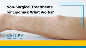 Non-Surgical Treatments for Lipomas: What Works?