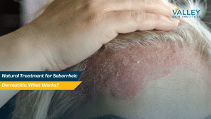 Natural Treatment for Seborrheic Dermatitis: What Works?