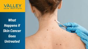 What Happens if Skin Cancer Goes Untreated